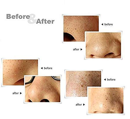 iKonbi Stainless Steel Blackhead Remover Round TipPack Of 4