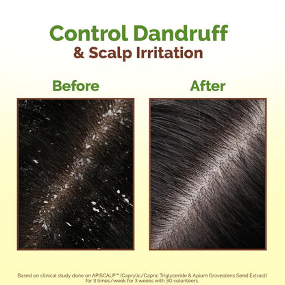 Mamaearth Lemon Anti-Dandruff HairOil for Flaky Scalp 100ml